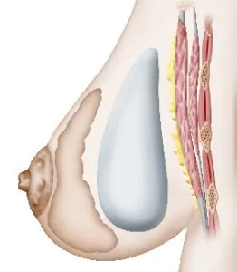 Augmentation mammaire Prothese premusculaire – Augmentation mammaire par prothèse