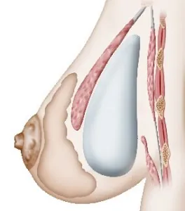 Augmentation mammaire Prothese retromusculaire – Augmentation mammaire par prothèse