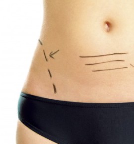 Marked abdomen for plastic surgery