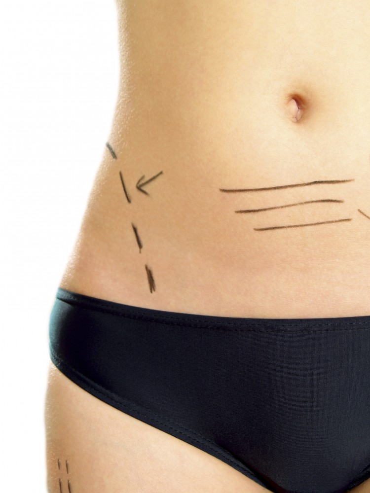 Marked abdomen for plastic surgery