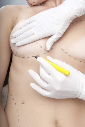 Plastic surgery doctor draw line on patient breast augmentation