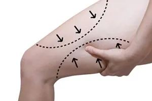 Lifting de cuisses