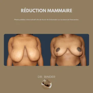 Publication REDUCTION MAMMAIRE 01 copie Avant et après une réduction mammaire