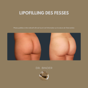 lipofilling-fesses-photo-01