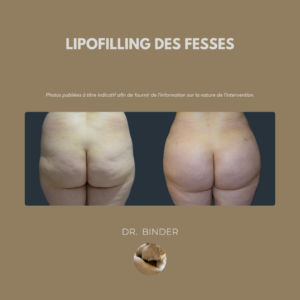 lipofilling-fesses-photo-02