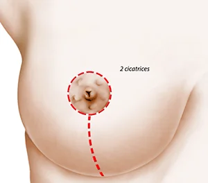 Schéma des cicatrices autour de l’aréole et verticale