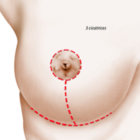 plastie-mammaire-reduction-3cicatrices