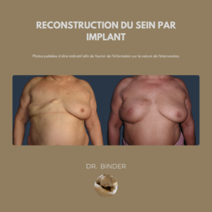 Reconstruction par implant mammaire