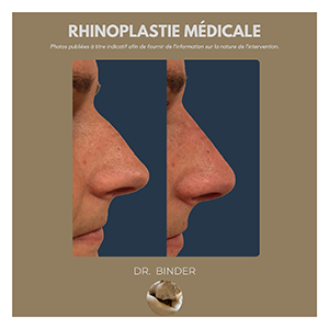 rhinoplastie-medicale-photos-01