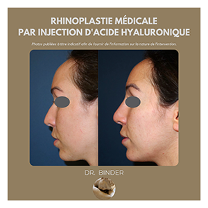 rhinoplastie-medicale-photos-02