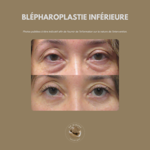Blépharoplastie inférieure