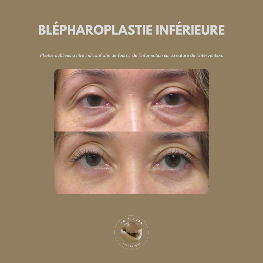 blepharoplastie-inferieure-photo-01