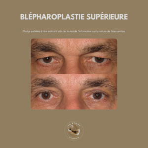Blépharoplastie supérieure