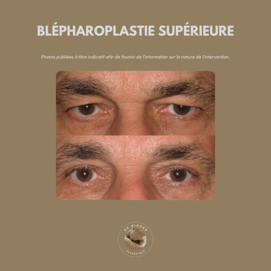 blepharoplastie-supérieure-photo-01