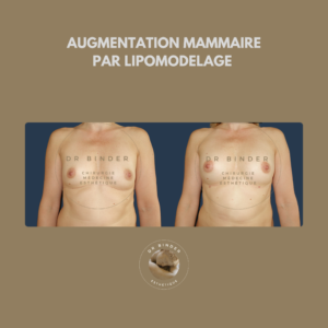 Augmentation mammaire par lipofilling