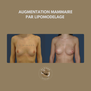 Augmentation mammaire par lipofilling