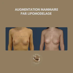 Avant et après une augmentation mammaire par lipofilling (transfert de graisse)