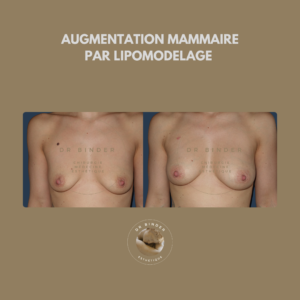 Augmentation mammaire par lipofilling