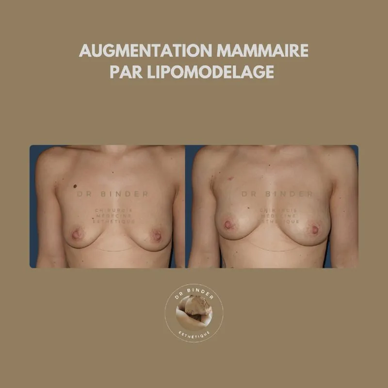 Avant et après une augmentation mammaire par lipofilling (transfert de graisse), photo publiée avec l’accord du patient