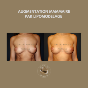 Augmentation mammaire par lipofilling