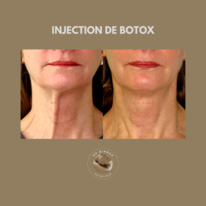 Injection de Botox, traitement des rides du cou