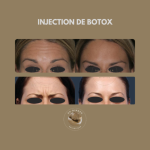 Injection de Botox, traitement des rides du lion et des rides horizontales du front