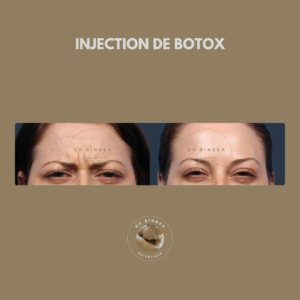 Injection de Botox, traitement des rides du lion