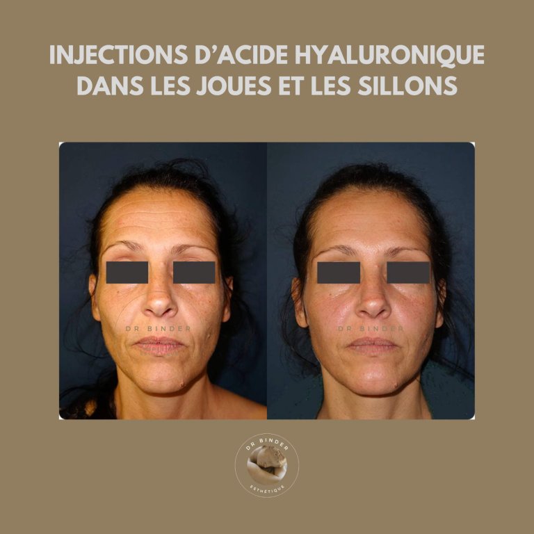 Avant et après des injections d’acide hyaluronique dans les joues et les sillons, photo publiée avec l’accord de la patiente