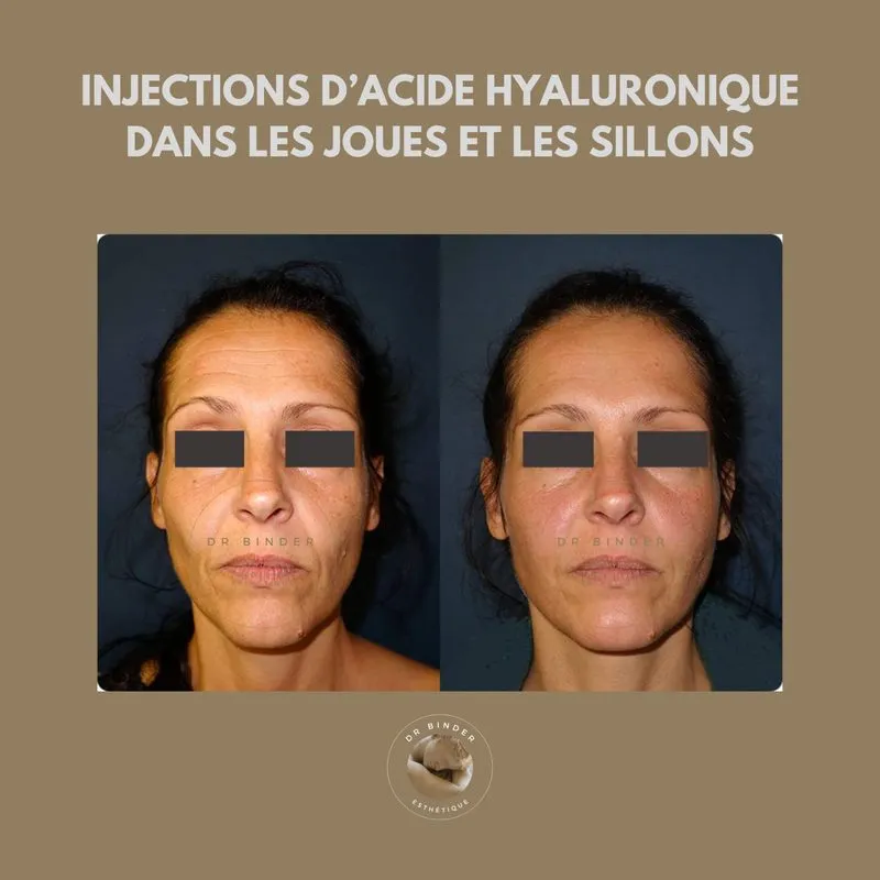 Avant et après des injections d’acide hyaluronique dans les joues et les sillons, photo publiée avec l’accord de la patiente