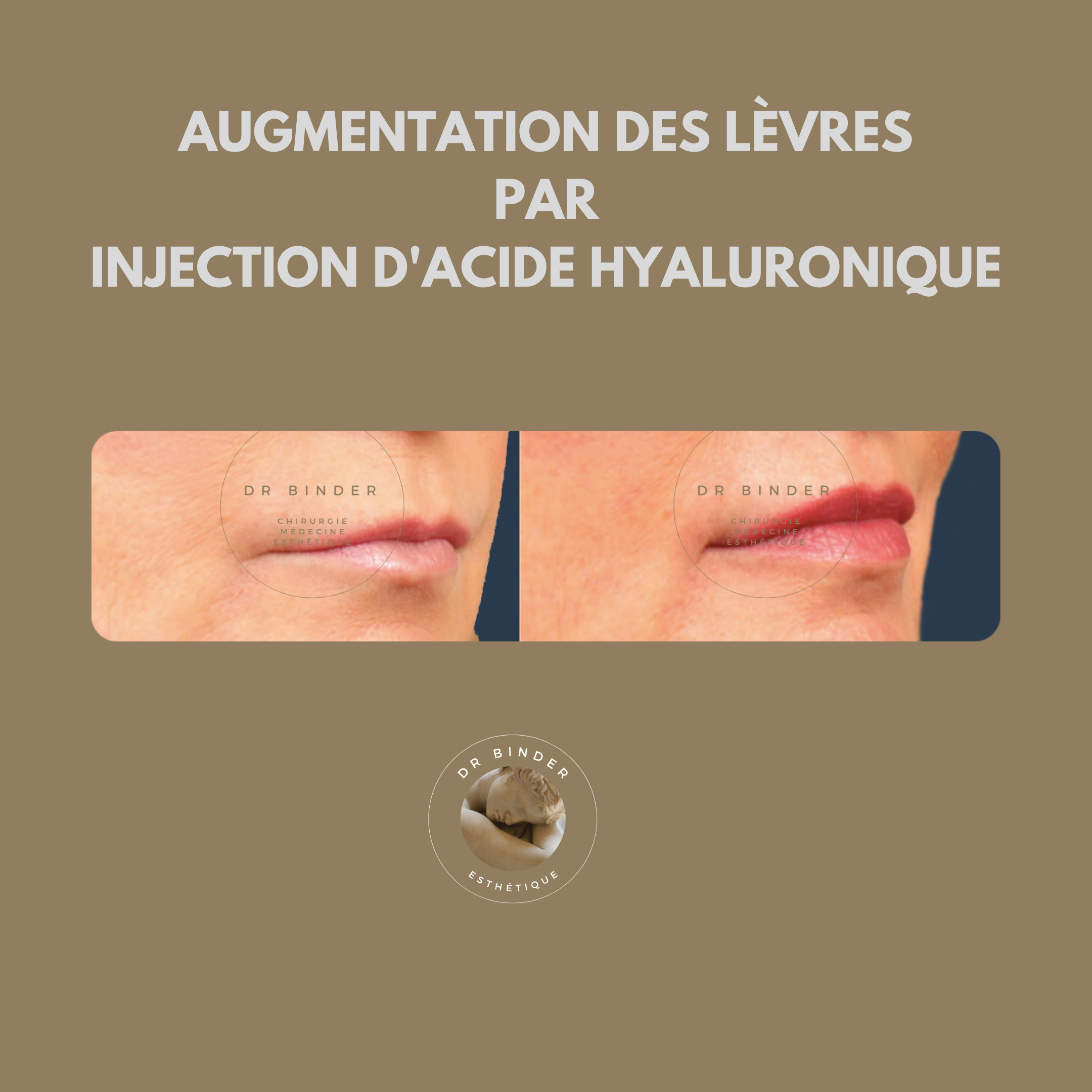 Injection de Botox, augmentation des lèvres