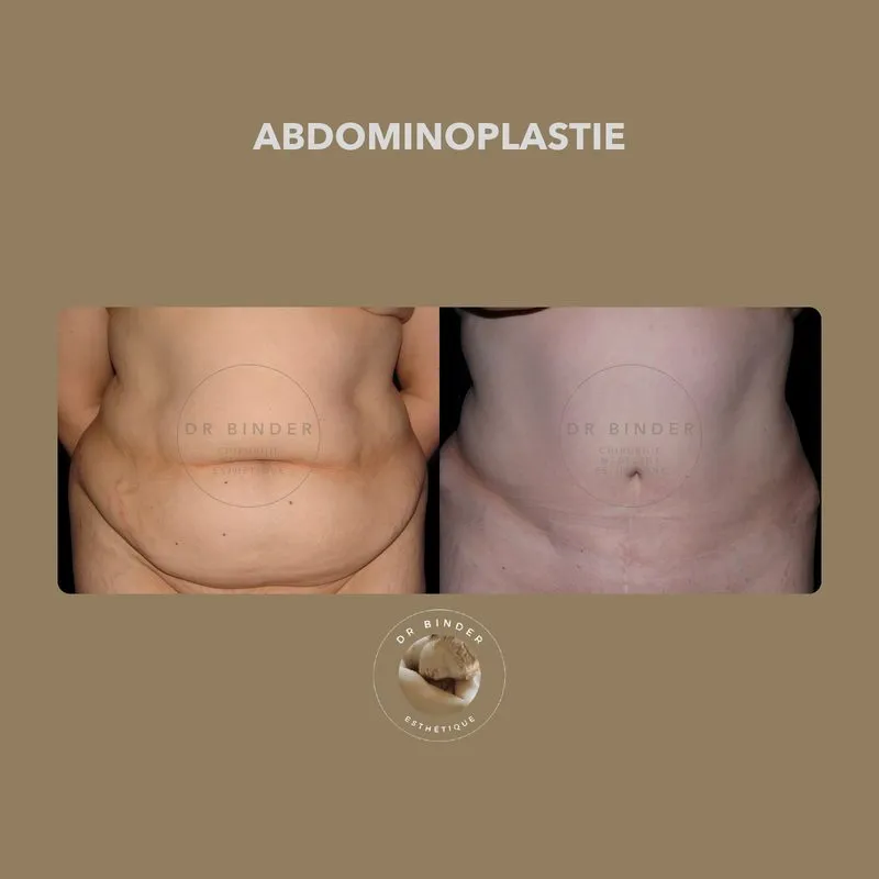Avant et après une abdominoplastie, de face, photo publiée avec l’accord de la patiente