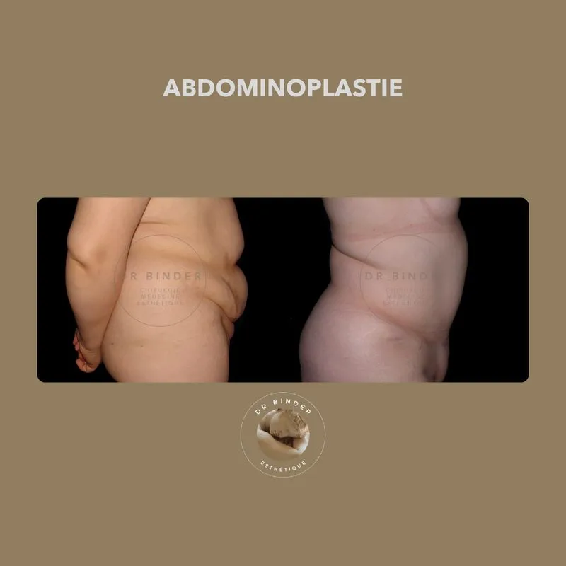 Avant et après une abdominoplastie, de profil, photo publiée avec l’accord de la patiente