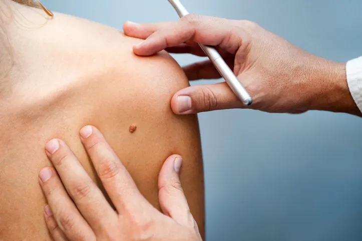 Examen d un grain de beauté avant une chirurgie des lésions cutanées