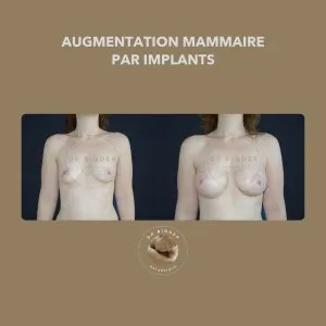 Avant et après une augmentation mammaire par implants, de face, photo publiée avec l’accord de la patiente