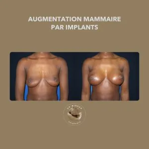 Avant et après une augmentation mammaire par implants, de face, photo publiée avec l’accord de la patiente