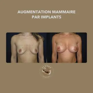 Avant et après une augmentation mammaire par implants, de face, photo publiée avec l’accord de la patiente