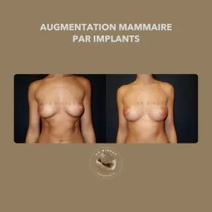 Avant et après une augmentation mammaire par implants, de face, photo publiée avec l’accord de la patiente