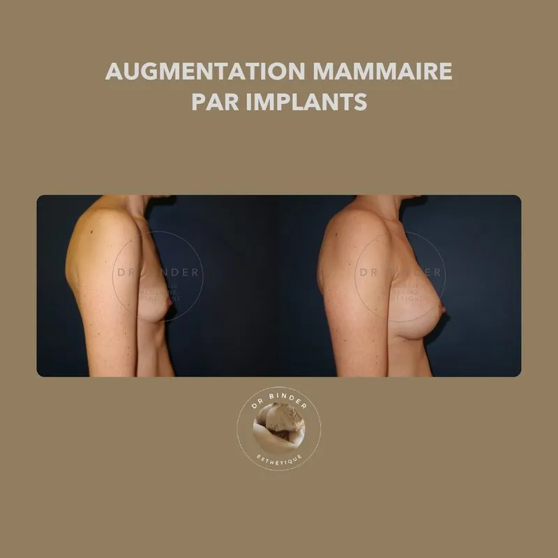 Avant et après une augmentation mammaire par implants, de profil, photo publiée avec l’accord de la patiente