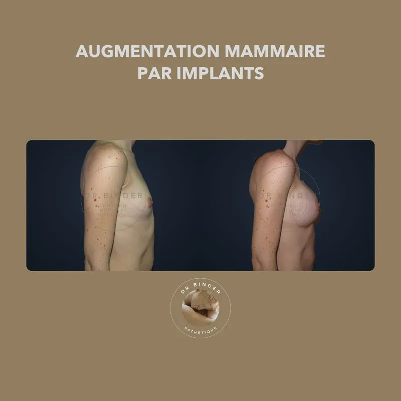 Avant et après une augmentation mammaire par implants, de profil, photo publiée avec l’accord de la patiente