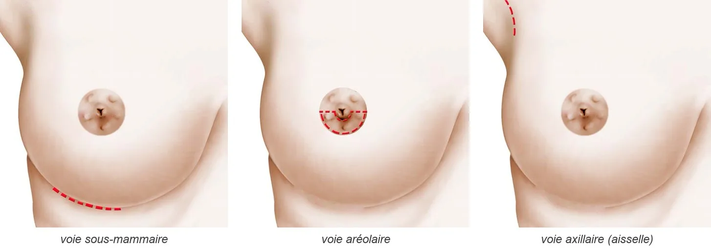 Schéma de trois seins vus de face montrant chacun une voie d’abord pour l’implant : sous-mammaire, aréolaire, axillaire