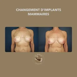 Avant et après un changement d’implants mammaires, de face, photo publiée avec l’accord de la patiente