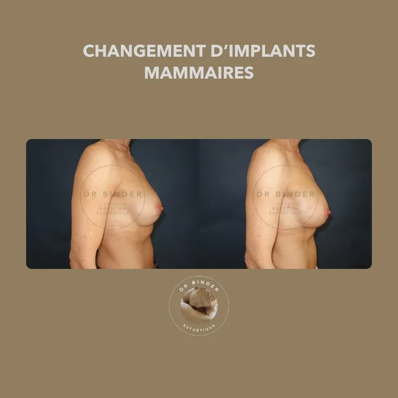Avant et après un changement d’implants mammaires, de profil, photo publiée avec l’accord de la patiente