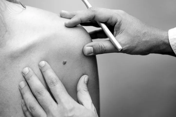 Examen d un grain de beauté de l épaule avant chirurgie (image de banque)