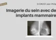 Imagerie du sein avec des implants mammaires : mammographie, échographie, IRM. Article du Dr Binder