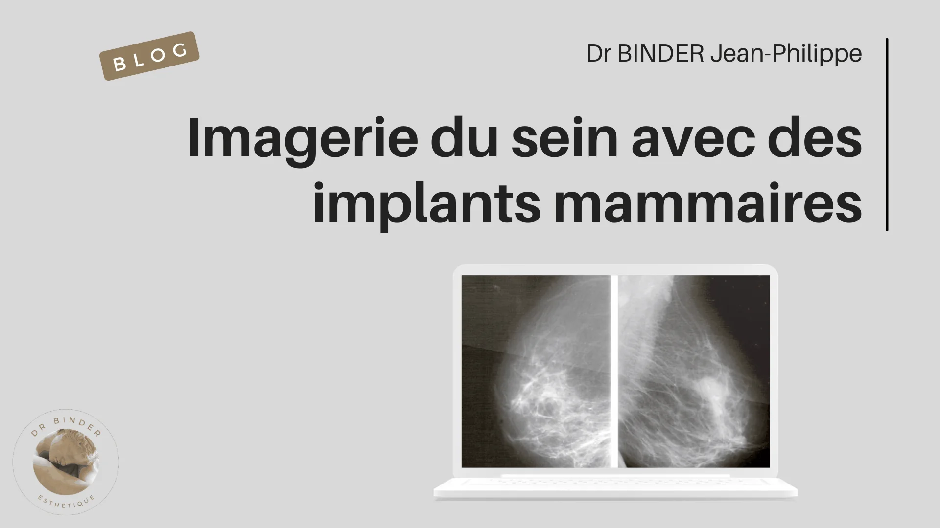 Imagerie du sein avec des implants mammaires : mammographie, échographie, IRM. Article du Dr Binder