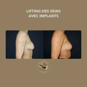 Avant et après un lifting des seins associé à des implants, de profil, photo publiée avec l’accord de la patiente