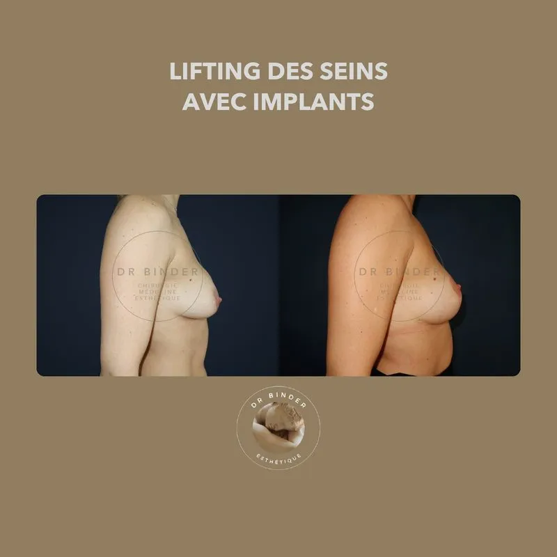 Avant et après un lifting des seins associé à des implants, de profil, photo publiée avec l’accord de la patiente
