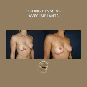 Avant et après un lifting des seins associé à des implants, de trois-quarts, photo publiée avec l’accord de la patiente