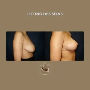 Lifting des seins (mastopexie), de profil Avant et après un lifting des seins (mastopexie), de profil, photo publiée avec l’accord de la patiente