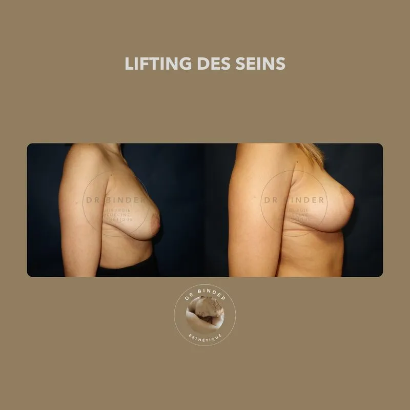 Avant et après un lifting des seins, de profil, photo publiée avec l’accord de la patiente